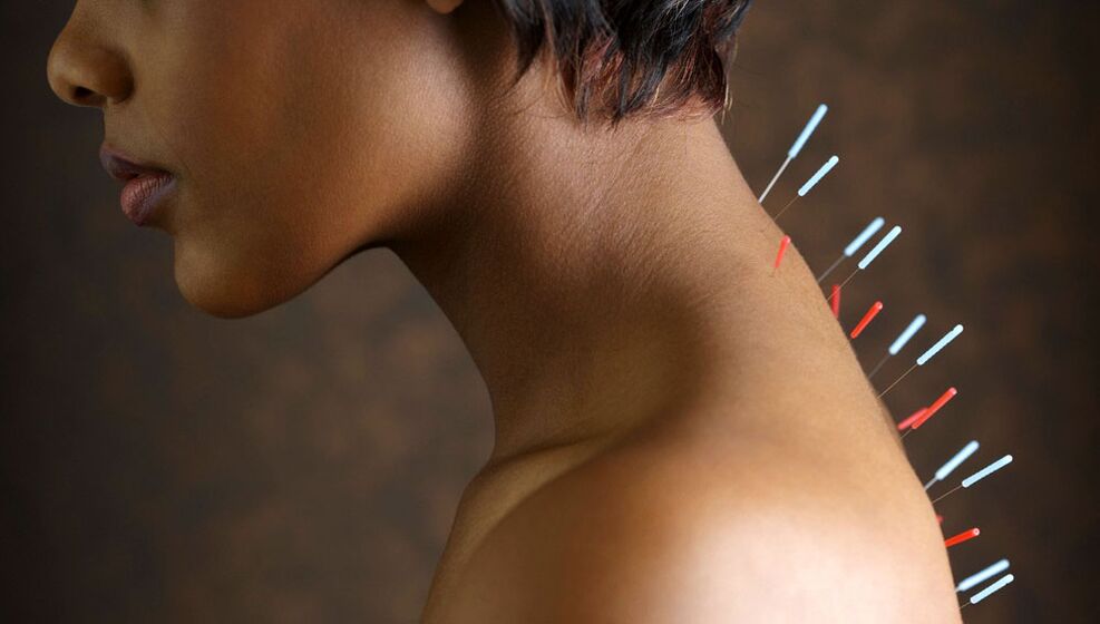 Acupuncture nga adunay cervical osteochondrosis