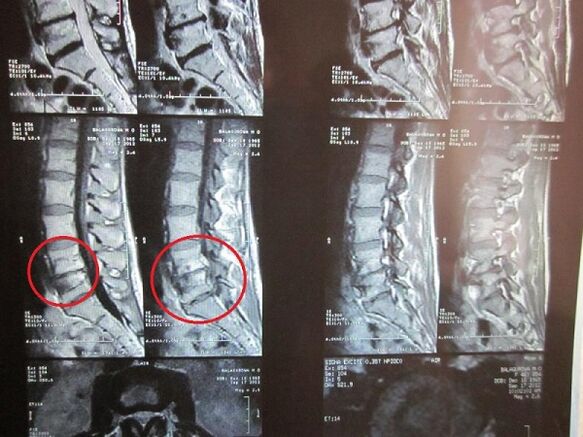 Diagnosis sa cervical osteochondrosis