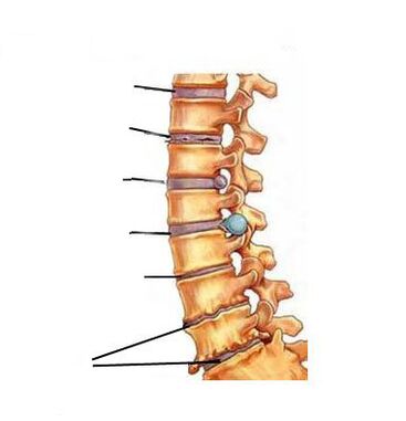 Giunsa ang pag-uswag sa osteochondrosis