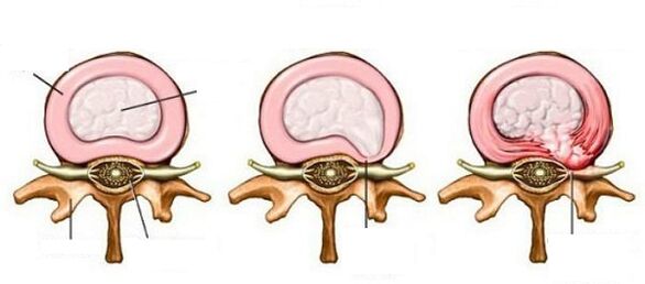 Intervertebral Hernia nga adunay cervical osteochondrosis