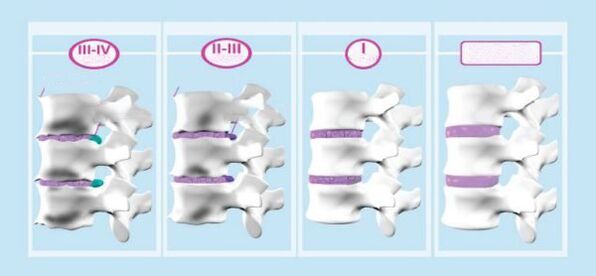 Mga yugto sa cervical osteochondrosis