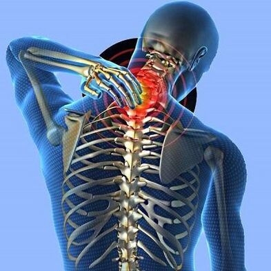 Sakit sa liog nga adunay cervical osteochondrosis