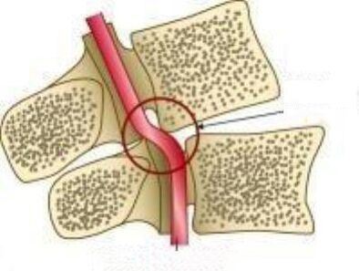 VAID ARTERY SYNDROME