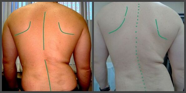 kurbada sa spine nga adunay osteochondrosis