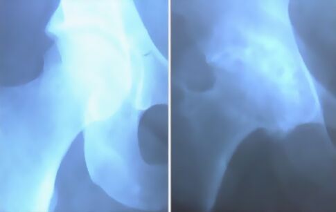 Scum sa arthrosis sa lutahan sa tuhod