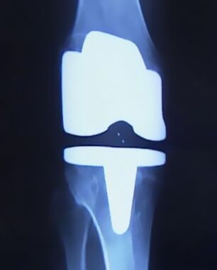 X -Ray nga litrato sa tuhod nga adunay usa ka artipisyal nga prosthesis pagkahuman sa operasyon aron mabag-o ang hiniusa