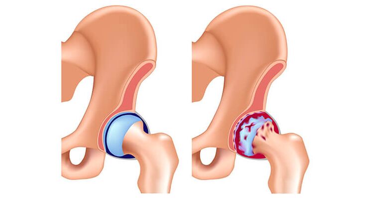 himsog ug naapektuhan sa arthrosis nga hip joint