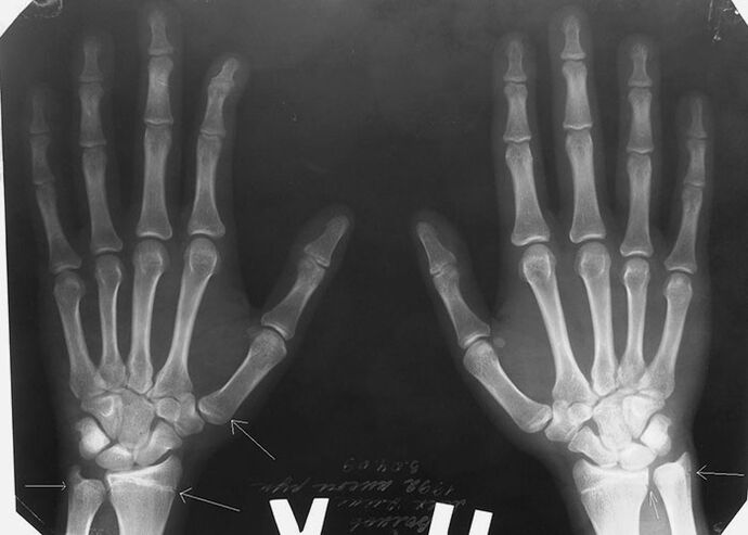 X-ray alang sa kasakit sa mga lutahan sa mga tudlo