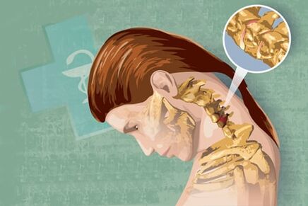 Mga Sintomas sa Reflex sa Osteochondrosis